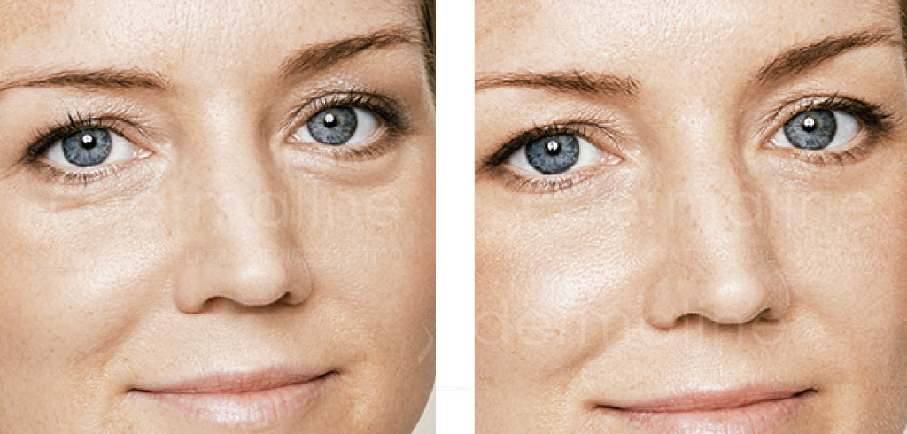 fotos-antes-despues-ojeras-galderma