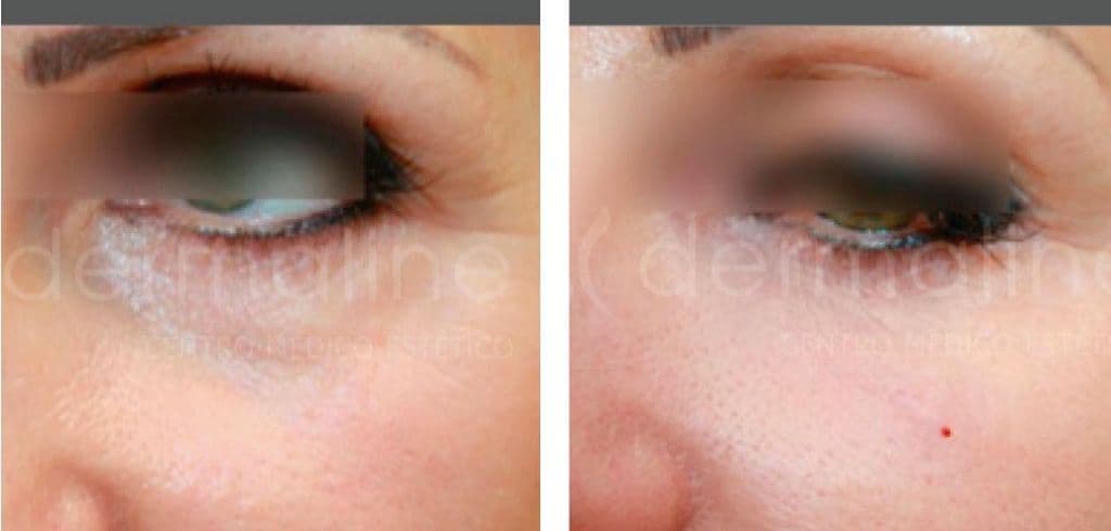 Ojeras dermaline (1)