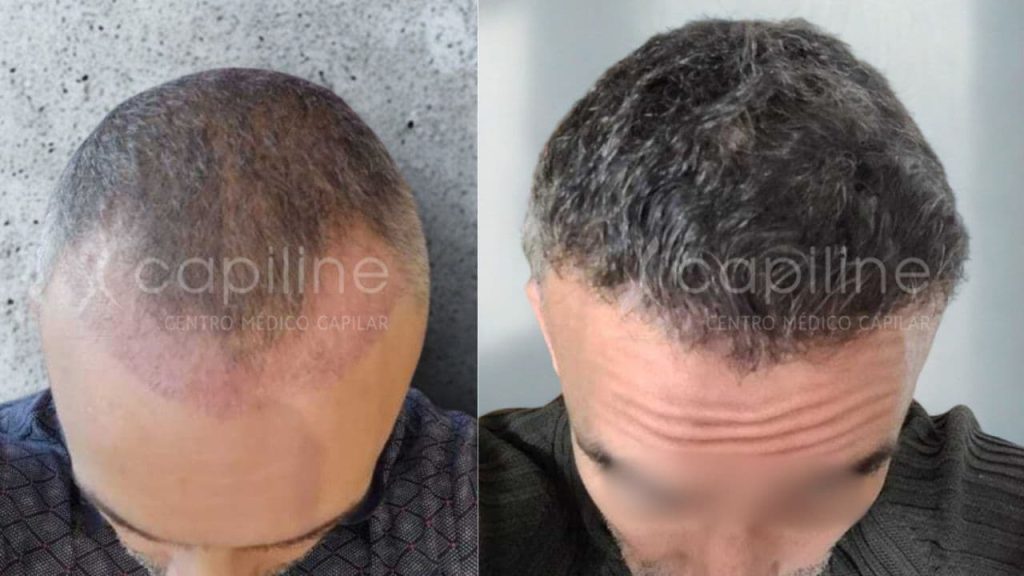 antes-y-despues-injerto-dermaline.jpg