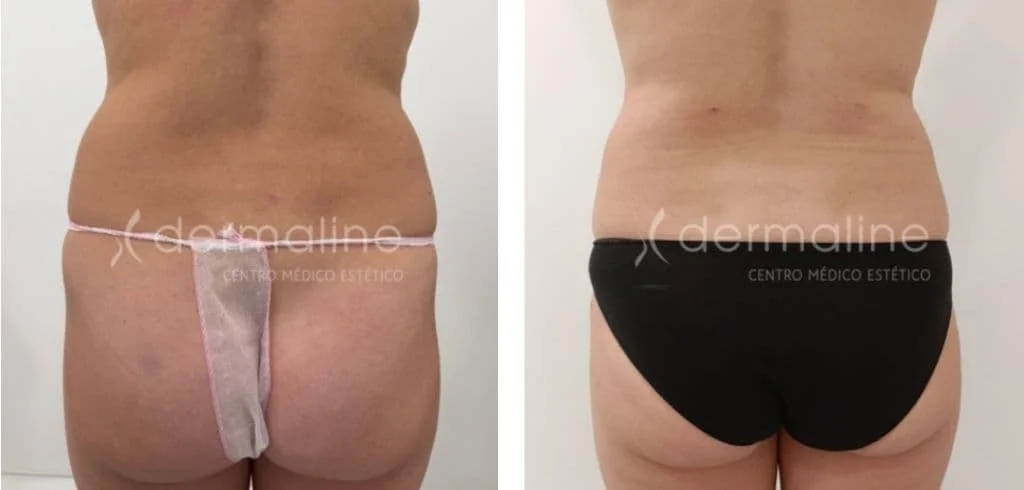 laser-lipolisis-dermaline-madrid (4)